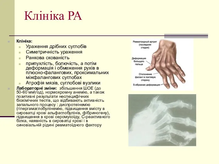 Клініка РА Клініка: Ураження дрібних суглобів Симетричність ураження Ранкова скованість