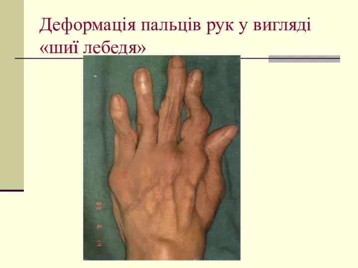 Деформація пальців рук у вигляді «шиї лебедя»