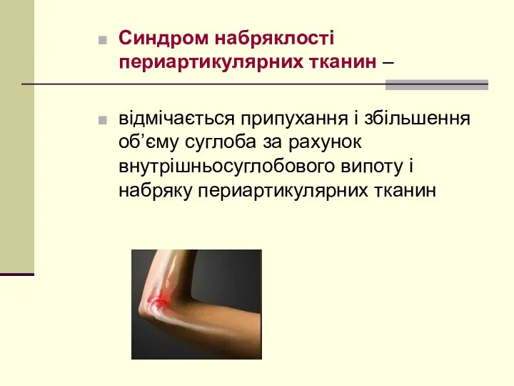 Синдром набряклості периартикулярних тканин – відмічається припухання і збільшення об’єму