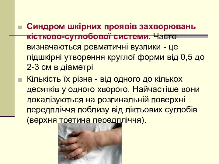 Синдром шкірних проявів захворювань кістково-суглобової системи. Часто визначаються ревматичні вузлики