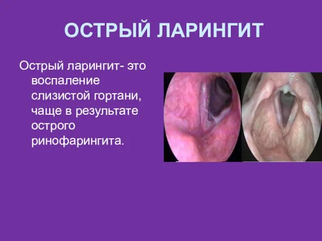 ОСТРЫЙ ЛАРИНГИТ Острый ларингит- это воспаление слизистой гортани, чаще в результате острого ринофарингита.