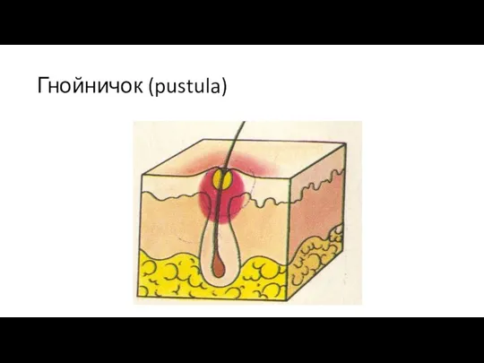 Гнойничок (pustula)