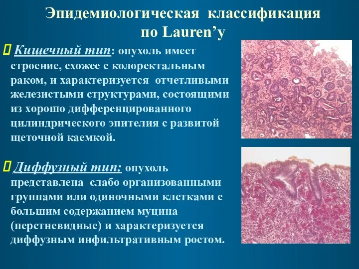 Эпидемиологическая классификация по Lauren’у Кишечный тип: опухоль имеет строение, схожее