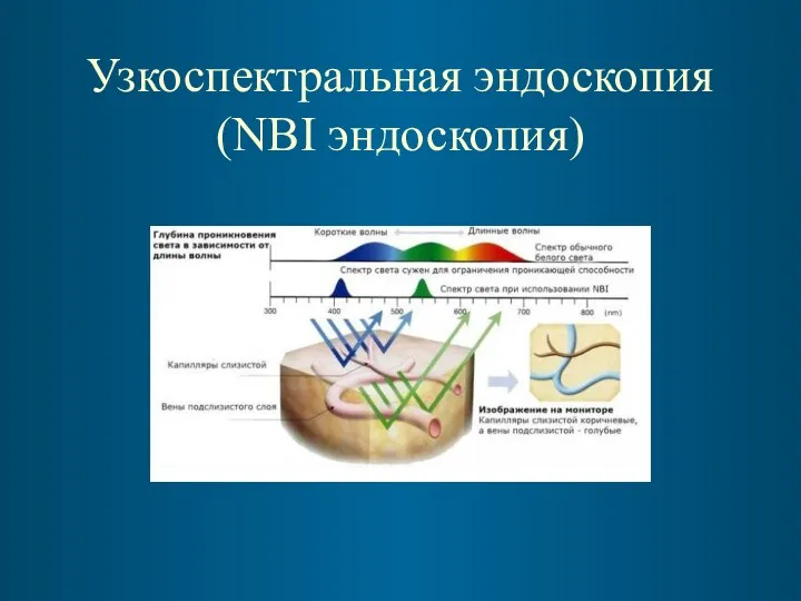Узкоспектральная эндоскопия (NBI эндоскопия)