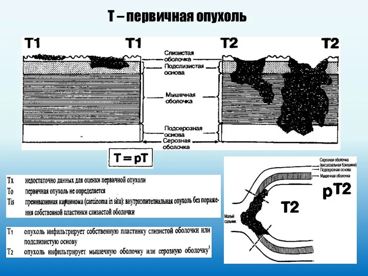 Т – первичная опухоль