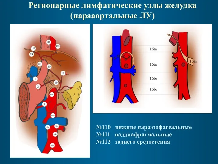 Регионарные лимфатические узлы желудка (парааортальные ЛУ) №110 нижние параэзофагеальные №111 наддиафрагмальные №112 заднего средостения