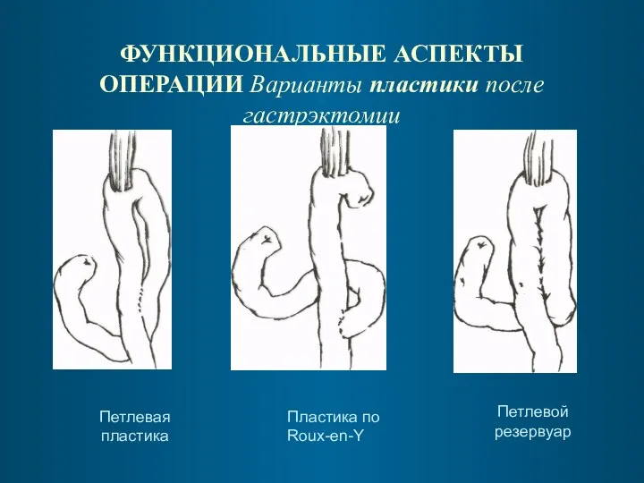 ФУНКЦИОНАЛЬНЫЕ АСПЕКТЫ ОПЕРАЦИИ Варианты пластики после гастрэктомии Петлевая пластика Пластика по Roux-en-Y Петлевой резервуар