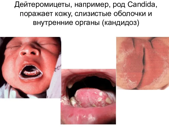 Дейтеромицеты, например, род Candida, поражает кожу, слизистые оболочки и внутренние органы (кандидоз)