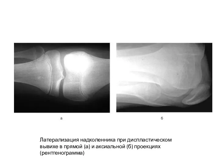 Латерализация надколенника при диспластическом вывихе в прямой (а) и аксиальной (б) проекциях (рентгенограмма)