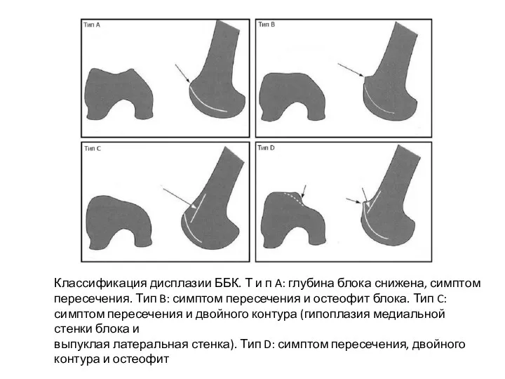 Классификация дисплазии ББК. Т и п A: глубина блока снижена,