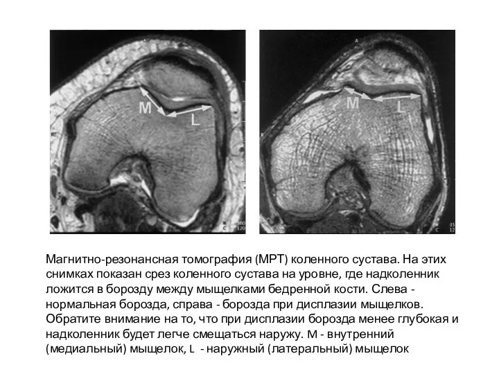 Магнитно-резонансная томография (МРТ) коленного сустава. На этих снимках показан срез