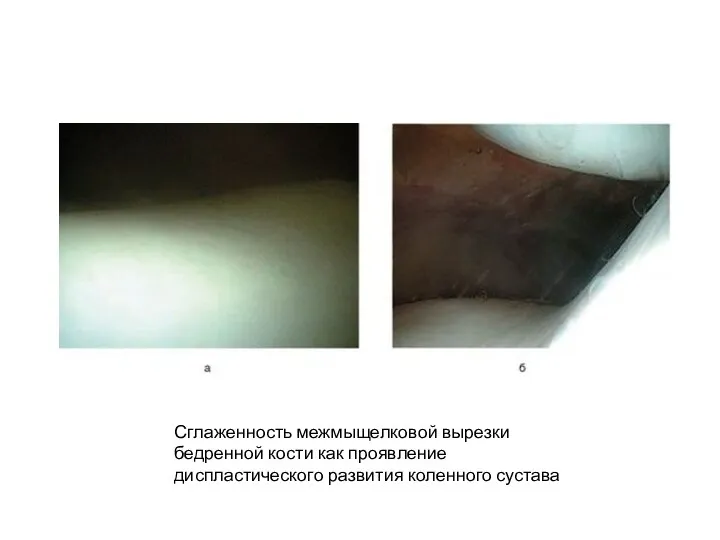 Сглаженность межмыщелковой вырезки бедренной кости как проявление диспластического развития коленного сустава