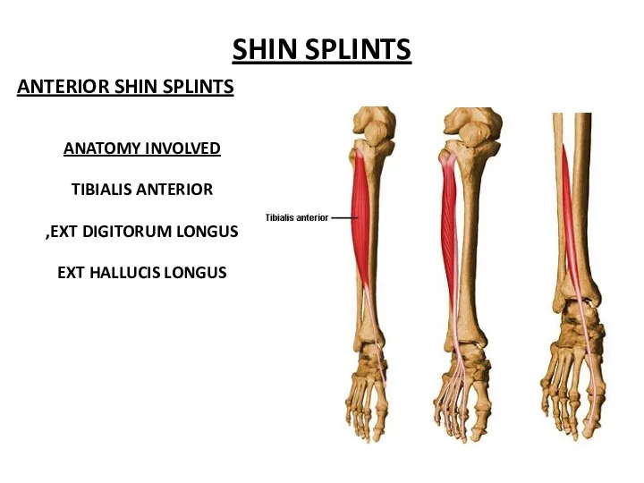 SHIN SPLINTS ANATOMY INVOLVED TIBIALIS ANTERIOR EXT DIGITORUM LONGUS, EXT HALLUCIS LONGUS ANTERIOR SHIN SPLINTS