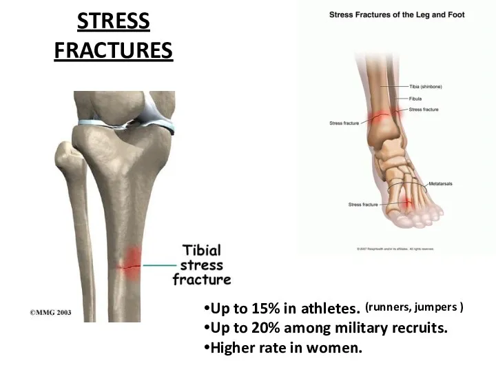 STRESS FRACTURES Up to 15% in athletes. Up to 20%