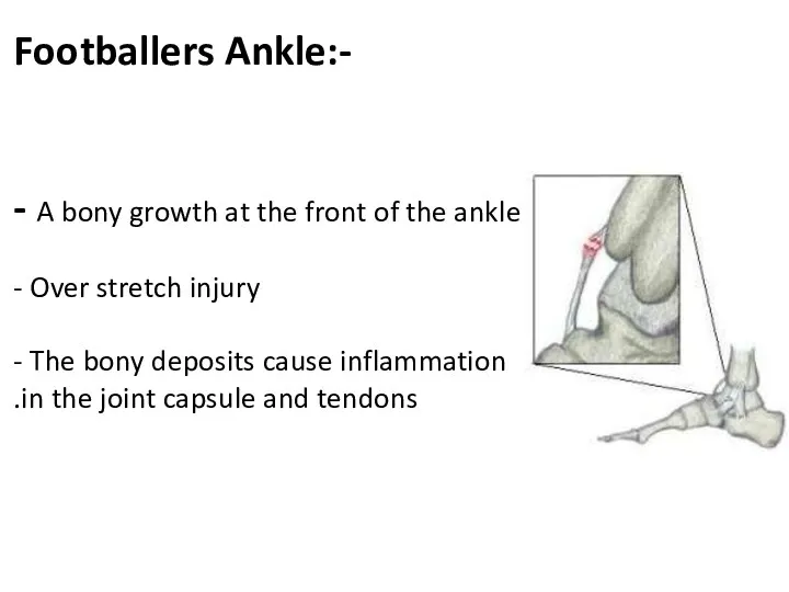 Footballers Ankle:- - A bony growth at the front of