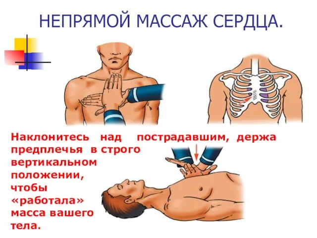 НЕПРЯМОЙ МАССАЖ СЕРДЦА. Наклонитесь над пострадавшим, держа предплечья в строго