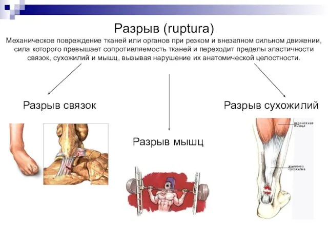 Разрыв (ruptura) Механическое повреждение тканей или органов при резком и