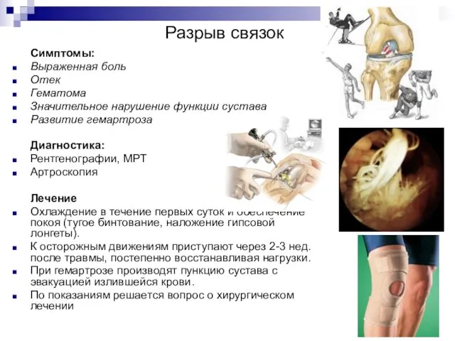 Разрыв связок Симптомы: Выраженная боль Отек Гематома Значительное нарушение функции