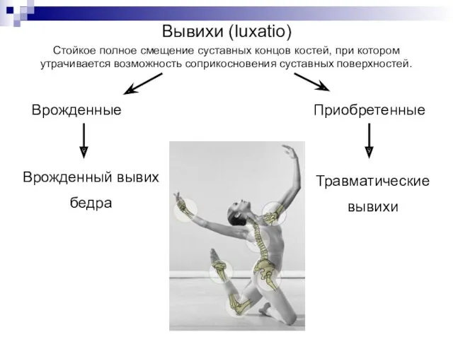 Вывихи (luxatio) Стойкое полное смещение суставных концов костей, при котором