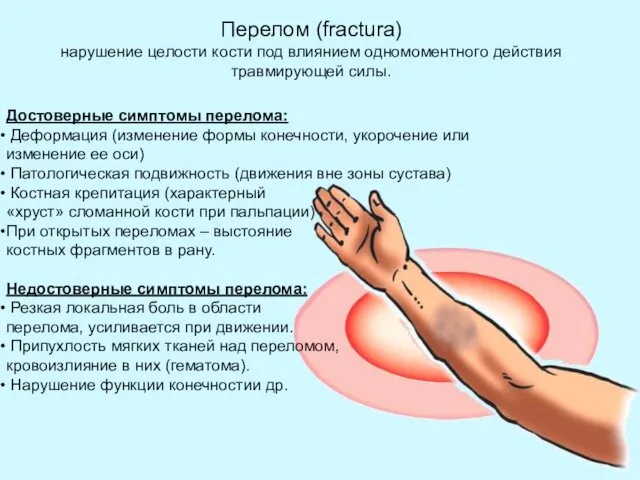 Достоверные симптомы перелома: Деформация (изменение формы конечности, укорочение или изменение