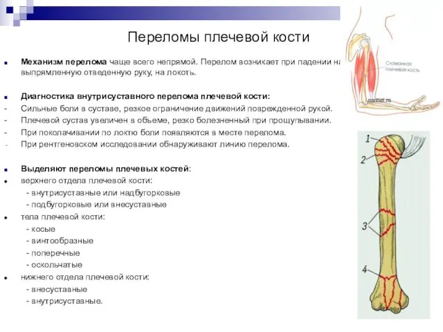 Переломы плечевой кости Механизм перелома чаще всего непрямой. Перелом возникает