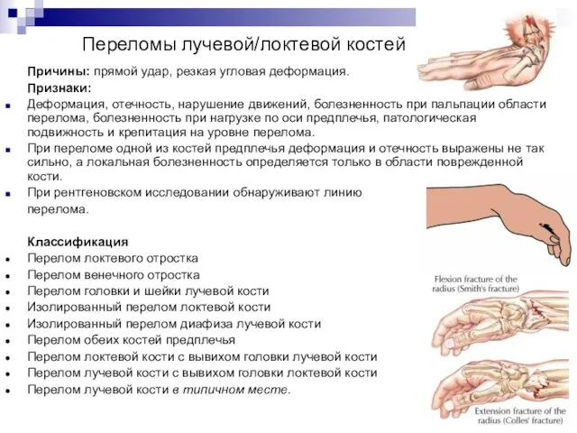 Переломы лучевой/локтевой костей Причины: прямой удар, резкая угловая деформация. Признаки: