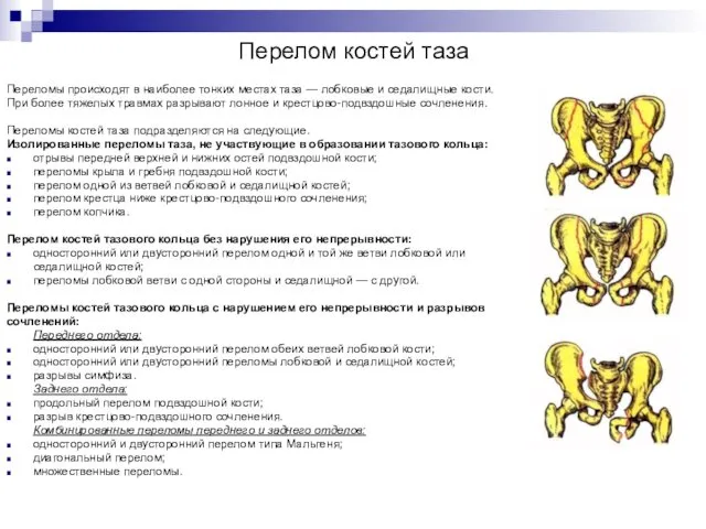 Перелом костей таза Переломы происходят в наиболее тонких местах таза