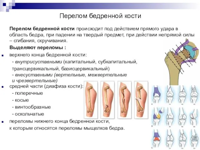 Перелом бедренной кости Перелом бедренной кости происходит под действием прямого