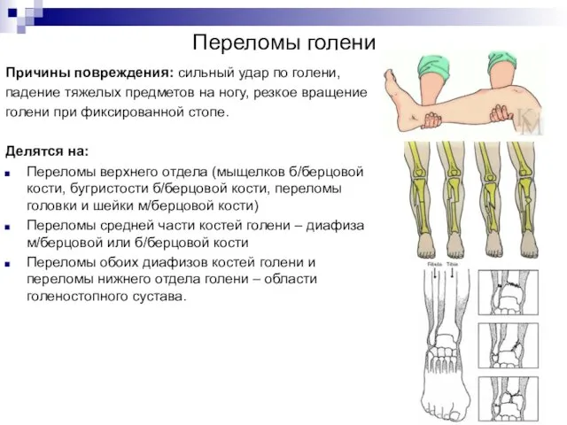 Переломы голени Причины повреждения: сильный удар по голени, падение тяжелых