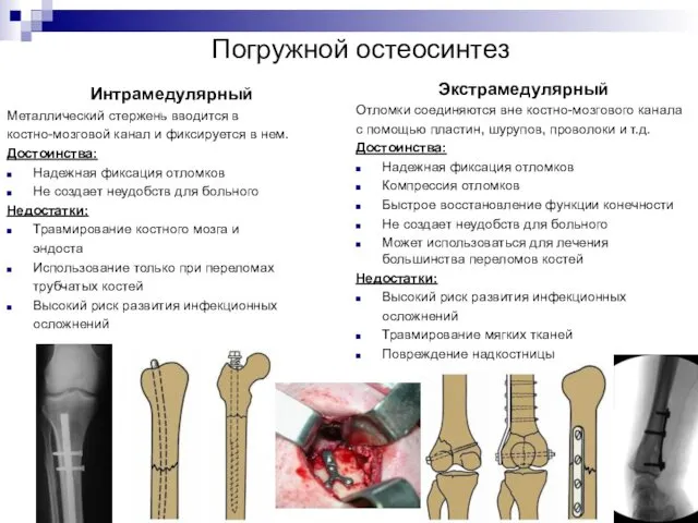 Погружной остеосинтез Интрамедулярный Металлический стержень вводится в костно-мозговой канал и