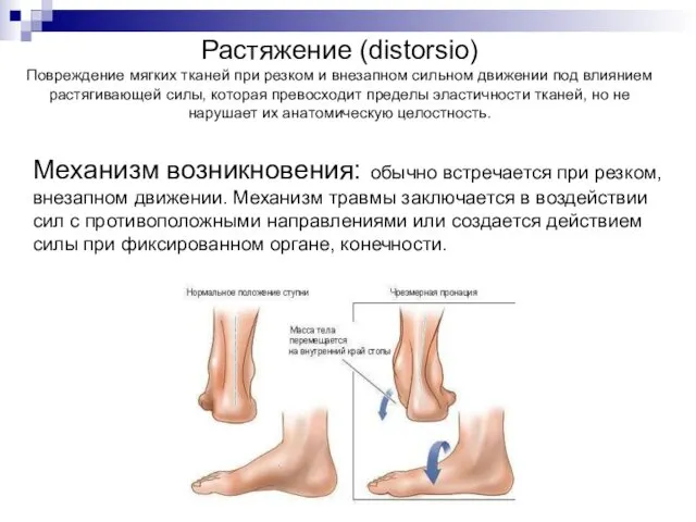 Растяжение (distorsio) Повреждение мягких тканей при резком и внезапном сильном