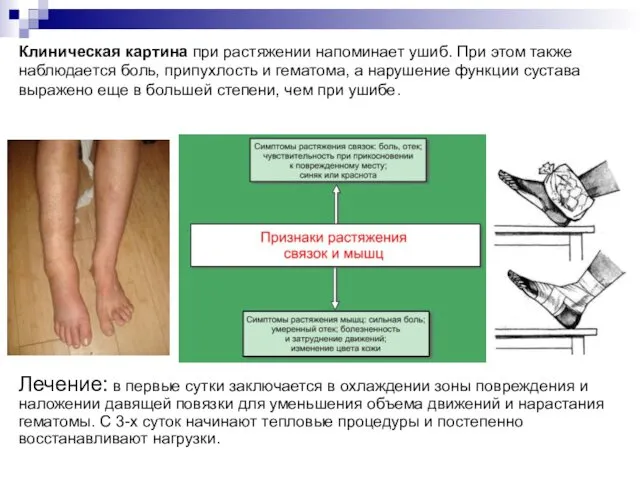 Клиническая картина при растяжении напоминает ушиб. При этом также наблюдается