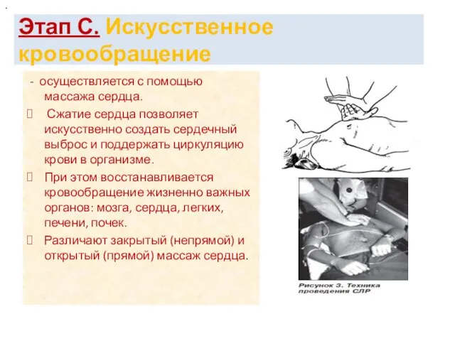 Этап С. Искусственное кровообращение - осуществляется с помощью массажа сердца.