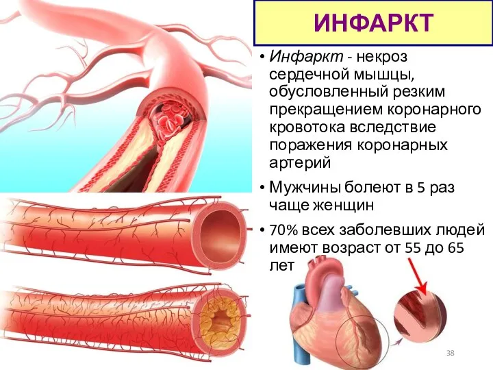 Инфаркт - некроз сердечной мышцы, обусловленный резким прекращением коронарного кровотока
