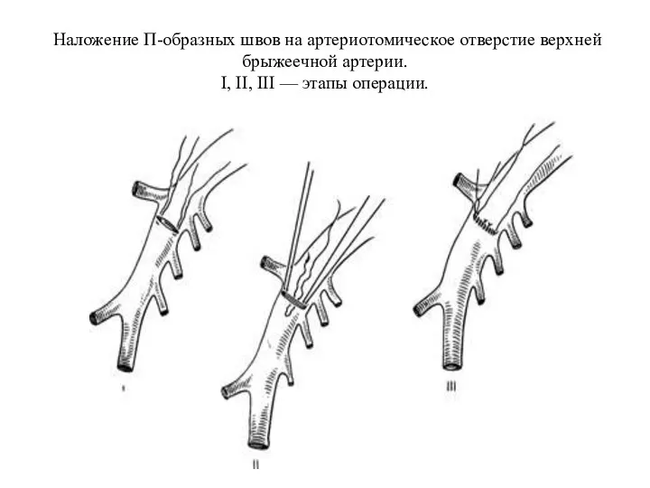 Наложение П-образных швов на артериотомическое отверстие верхней брыжеечной артерии. I, II, III — этапы операции.
