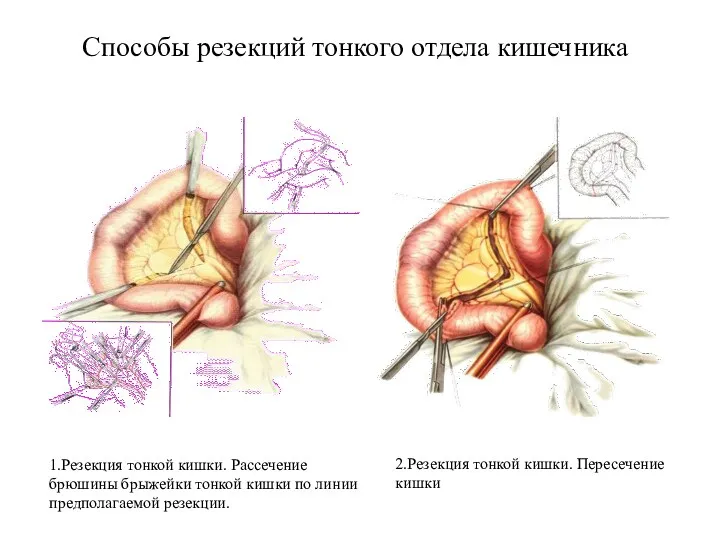 Способы резекций тонкого отдела кишечника 1.Резекция тонкой кишки. Рассечение брюшины