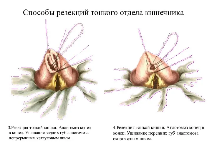 Способы резекций тонкого отдела кишечника 3.Резекция тонкой кишки. Анастомоз конец