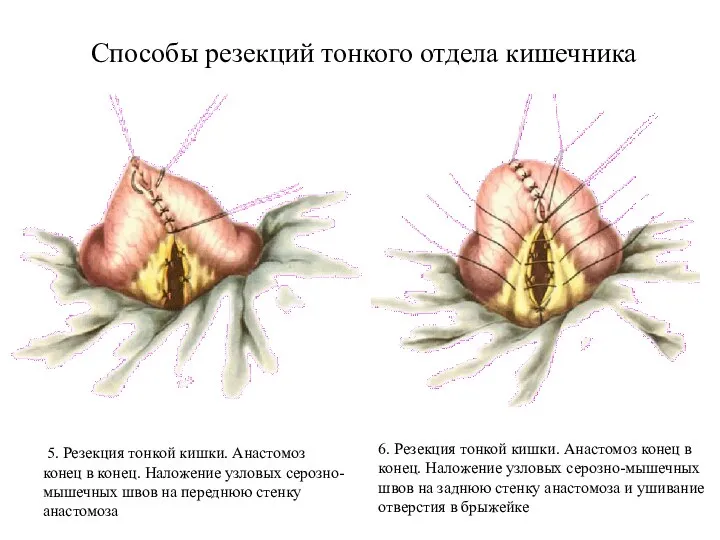 Способы резекций тонкого отдела кишечника 5. Резекция тонкой кишки. Анастомоз