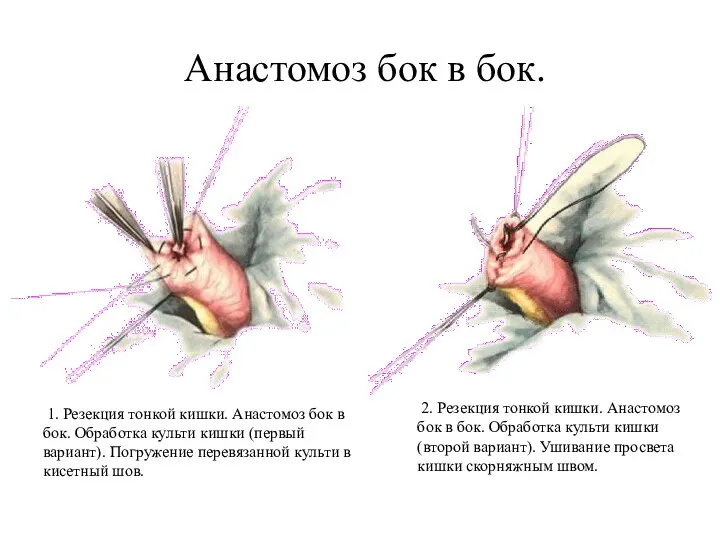 Анастомоз бок в бок. 1. Резекция тонкой кишки. Анастомоз бок