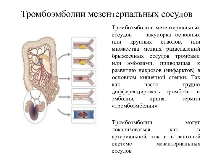 Тромбоэмболии мезентериальных сосудов Тромбоэмболии мезентериальных сосудов — закупорка основных или