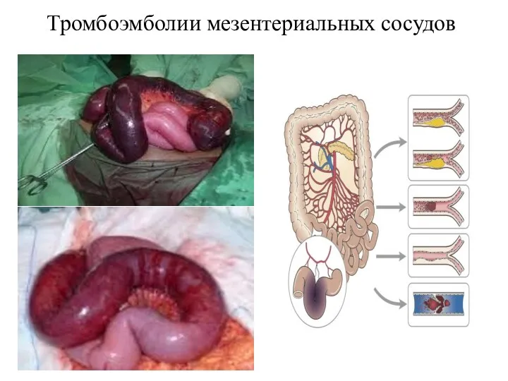 Тромбоэмболии мезентериальных сосудов