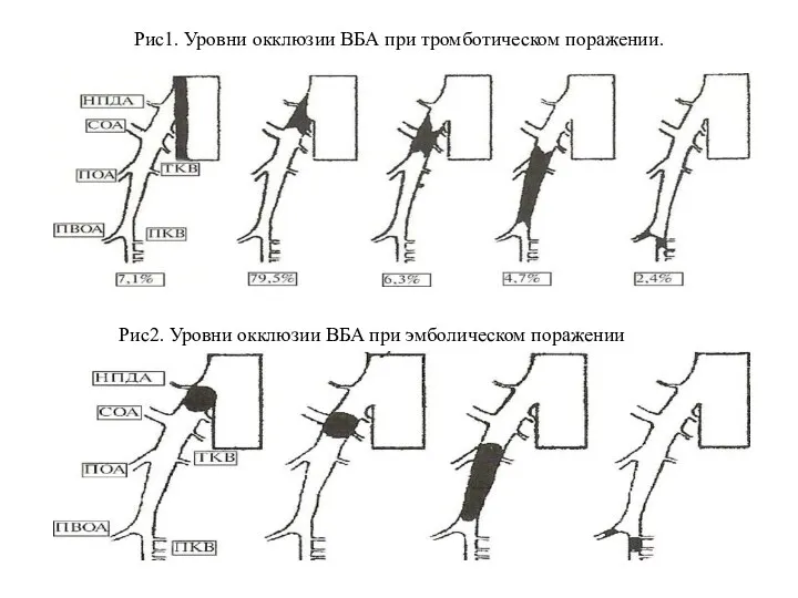 Рис1. Уровни окклюзии ВБА при тромботическом поражении. Рис2. Уровни окклюзии ВБА при эмболическом поражении