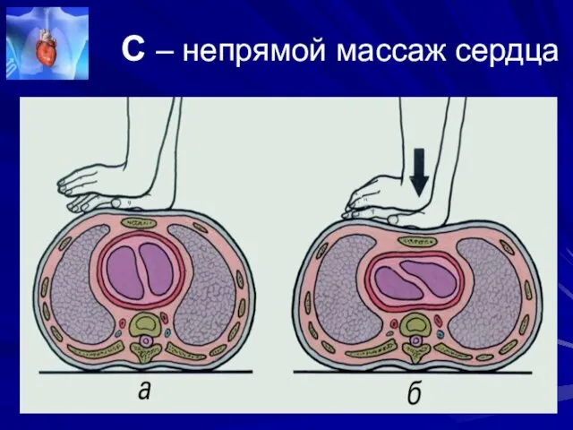 С – непрямой массаж сердца