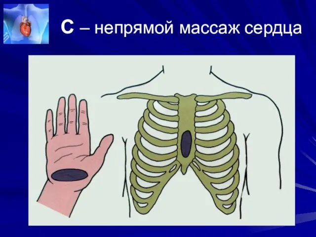 С – непрямой массаж сердца