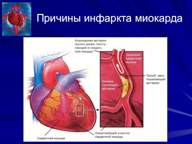 Причины инфаркта миокарда