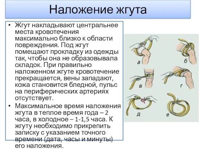 Наложение жгута Жгут накладывают центральнее места кровотечения максимально близко к