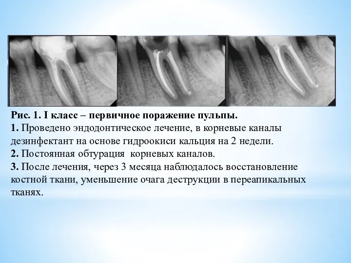 Рис. 1. I класс – первичное поражение пульпы. 1. Проведено