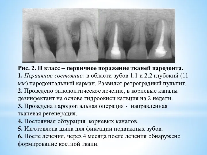 Рис. 2. II класс – первичное поражение тканей пародонта. 1.