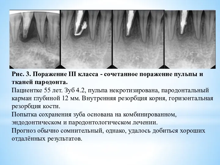 Рис. 3. Поражение III класса - сочетанное поражение пульпы и