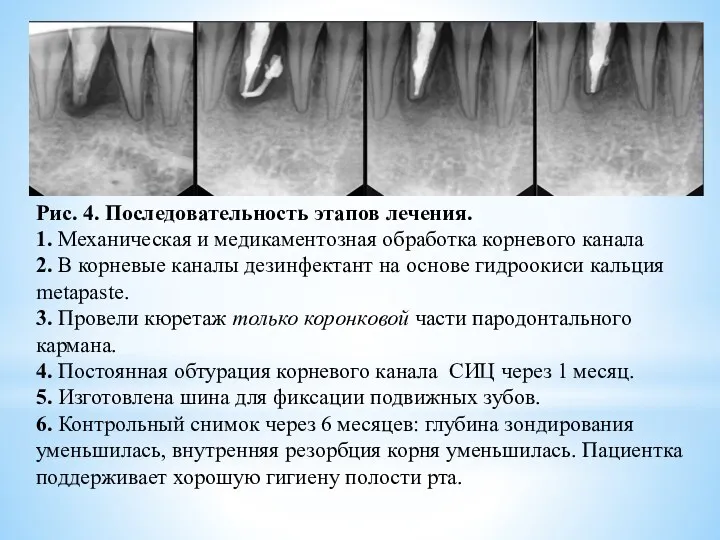 Рис. 4. Последовательность этапов лечения. 1. Механическая и медикаментозная обработка